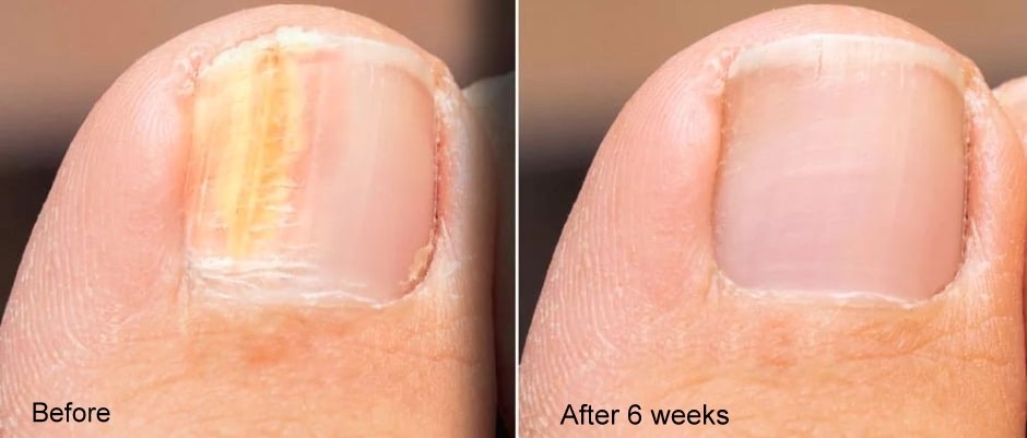 EELHOE care toenail solution (2Pack deal)